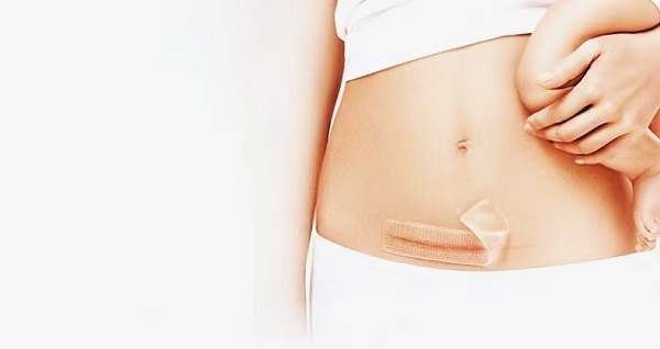 لماذا تحظى صفائح الندبات المصنوعة من جل السيليكون السميكة بشعبية كبيرة؟